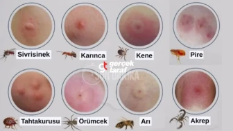Böcek Isırıkları ve Belirtileri, Tedavi Yöntemleri