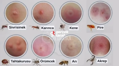 Böcek Isırıkları ve Belirtileri, Tedavi Yöntemleri