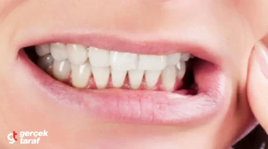 Strese Bağlı Bruksizm Yaygınlaşıyor