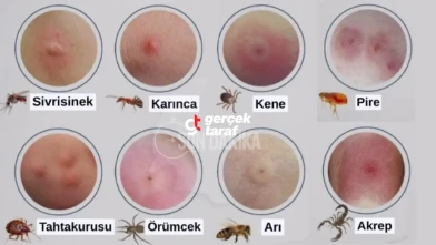 Böcek Isırıkları ve Belirtileri, Tedavi Yöntemleri