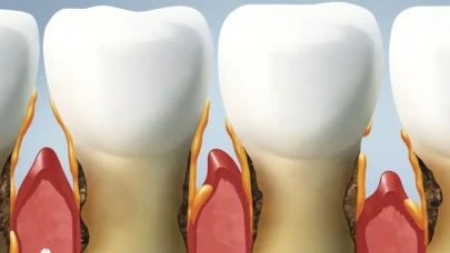 Agresif Periodontitis: Erken Teşhis Edilmezse Diş ve Çene Kaybına Yol Açıyor