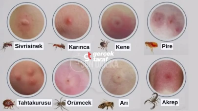 Böcek Isırıkları ve Belirtileri, Tedavi Yöntemleri