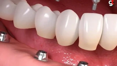 Diş İmplantı Sonrası Nasıl Beslenmeliyiz? Nelere Dikkat Etmeliyiz?