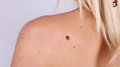 Vücudumuz da Ben Neden Çıkar? Benler Zararlı mıdır?