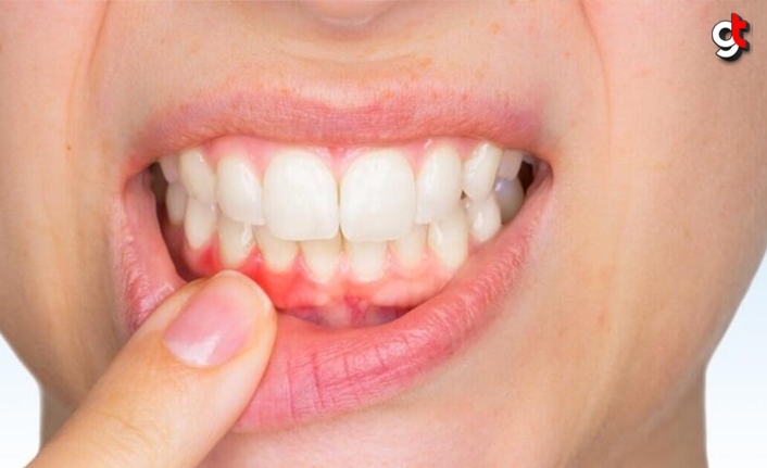 Diş Eti Kanamaları neden olur, tedavisi nelerdir?